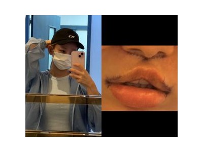 맹승지 인중축소수술 했다고 고백해